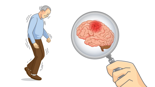 Parkinson's disease